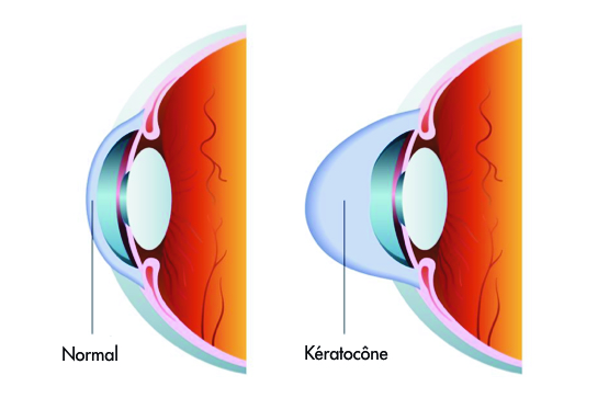 Kératocône pathologie de la cornée